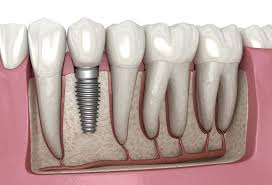 implant-tedavisi-agrili-midir-FD6JHEr2.jpg