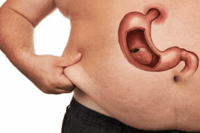 mide-kucultme-ameliyati-nedir-ve-kimlere-uygulanir-ISidj9wW.png