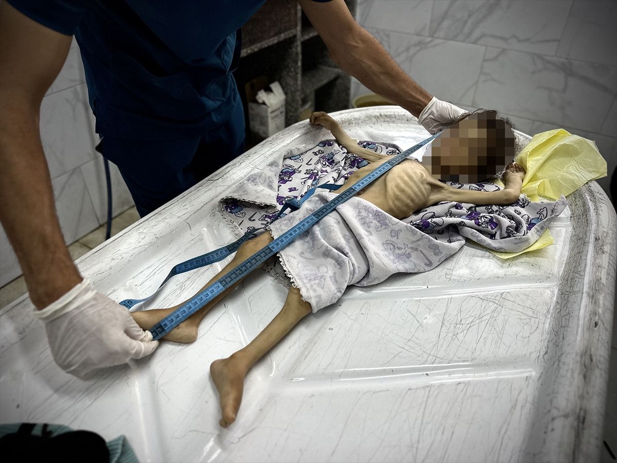 Gazzede Gıda Krizi: Bir Çocuğun Daha Yaşam Mücadelesi Son Buldu